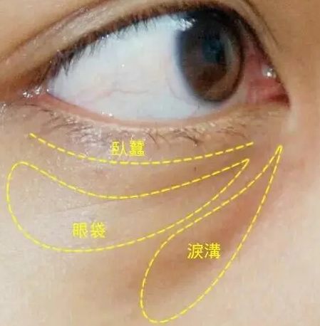 去眼袋手术