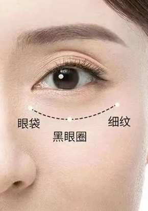 去眼袋手术