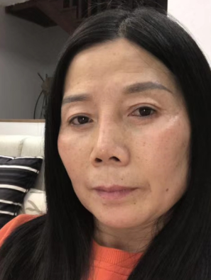 去眼袋手术