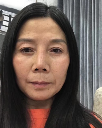 去眼袋手术