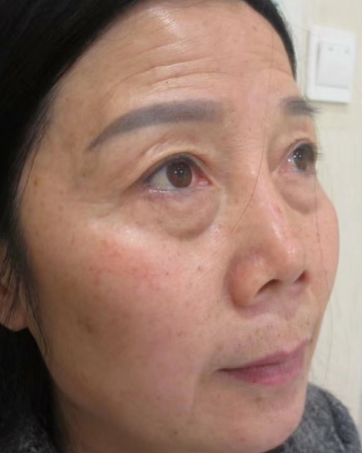 去眼袋手术