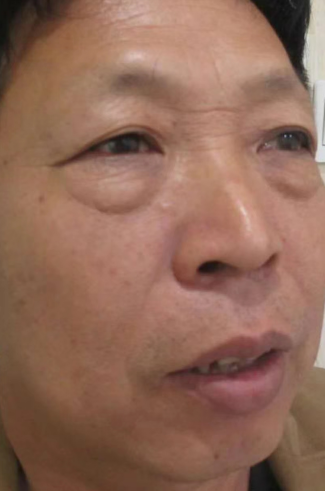 去眼袋手术