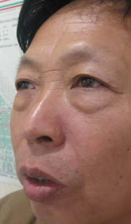 去眼袋手术