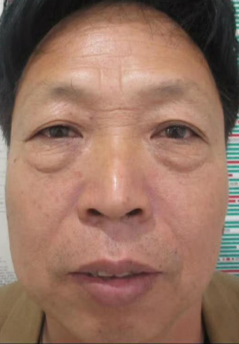 去眼袋手术