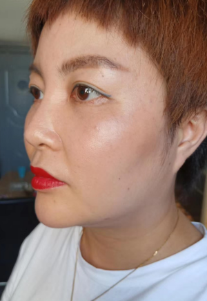 去眼袋手术