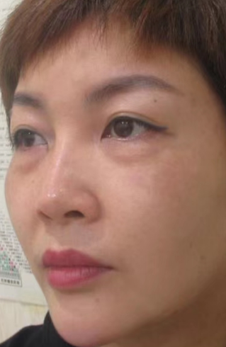 去眼袋手术