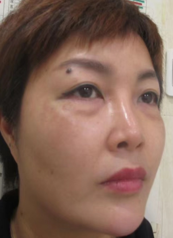 去眼袋手术