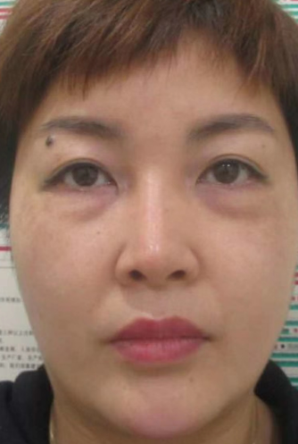 去眼袋手术