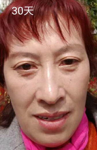 去眼袋手术