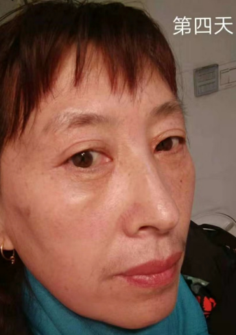 去眼袋手术