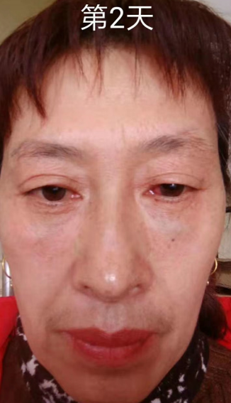 去眼袋手术