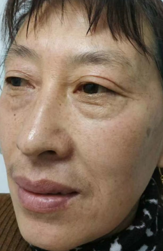 去眼袋手术