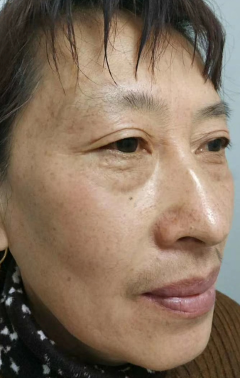 去眼袋手术