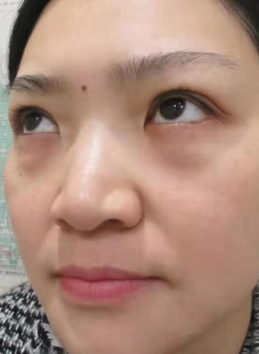 去眼袋手术
