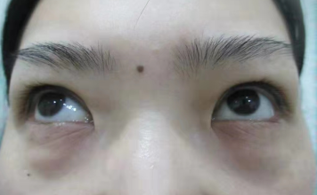 去眼袋手术