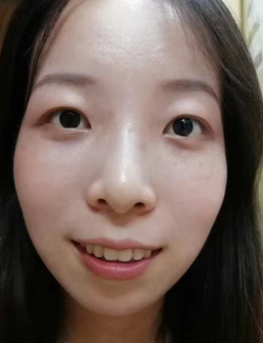 去眼袋手术