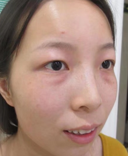去眼袋手术