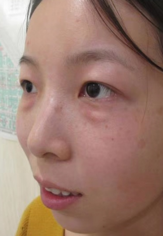 去眼袋手术