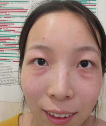去眼袋手术