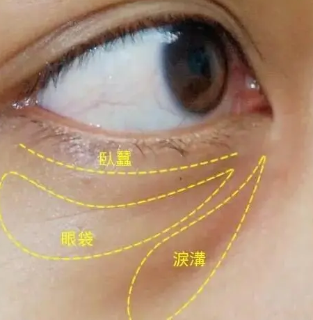 去眼袋手术