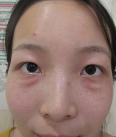 去眼袋手术