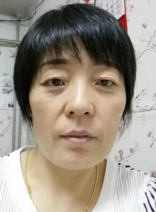 去眼袋手术