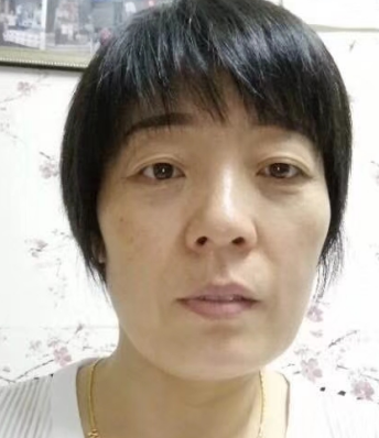 去眼袋手术