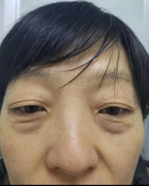 去眼袋手术