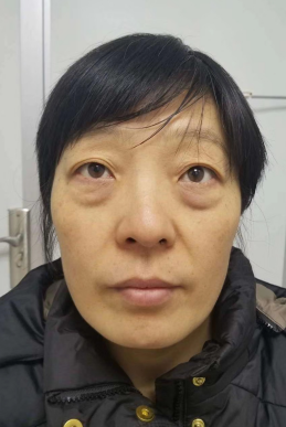 去眼袋手术