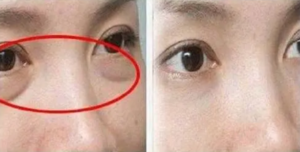 去眼袋手术