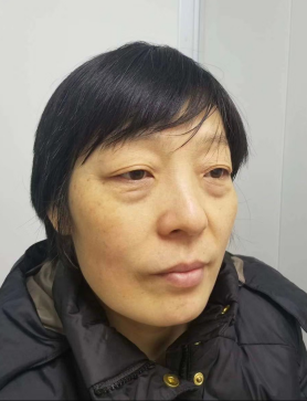 去眼袋手术