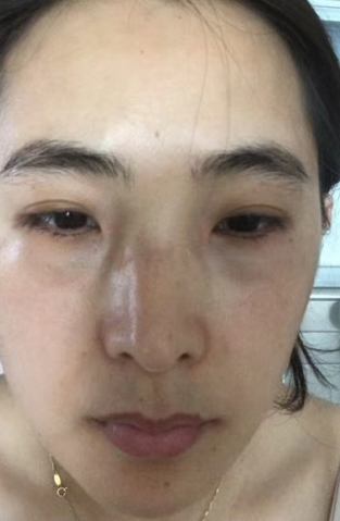 去眼袋手术