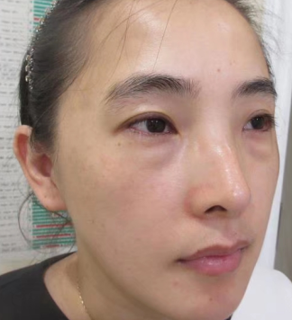 去眼袋手术