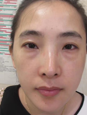 去眼袋手术