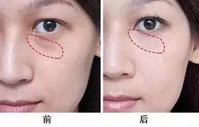 去眼袋手术