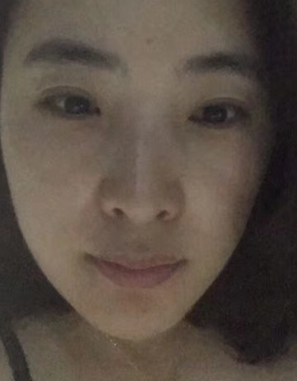 去眼袋手术
