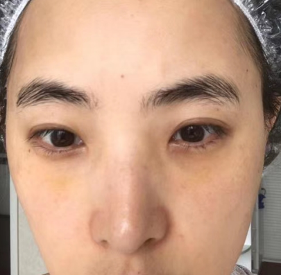 去眼袋手术