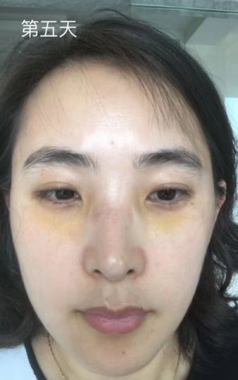 去眼袋手术