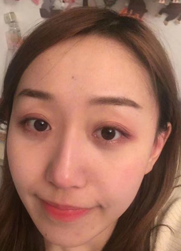 去眼袋手术