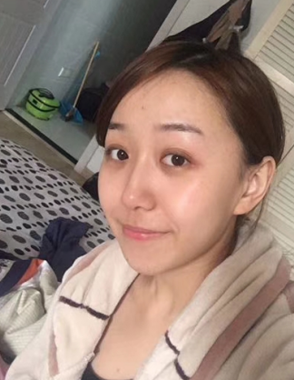 去眼袋手术