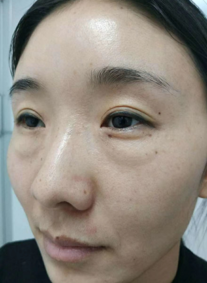 去眼袋手术