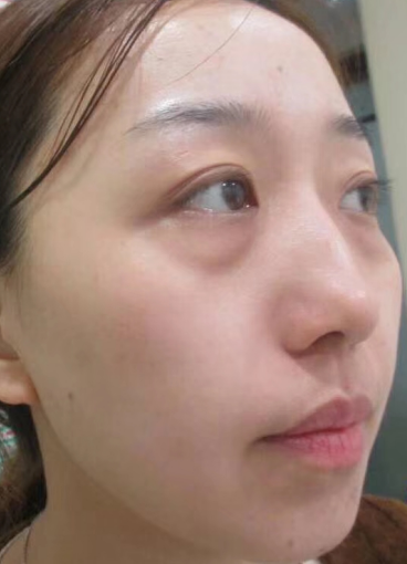 去眼袋手术