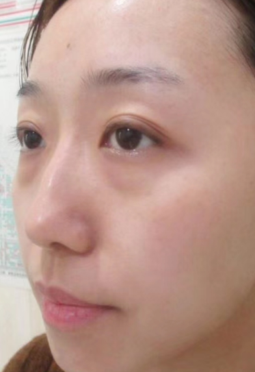 去眼袋手术