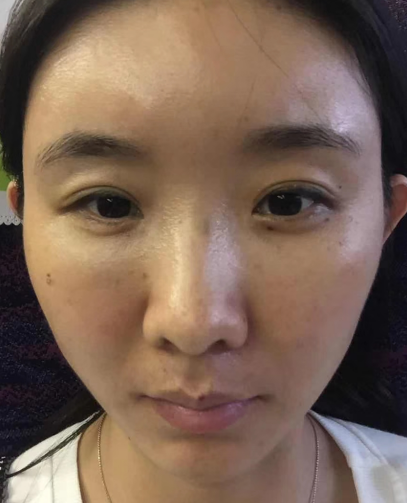 去眼袋手术
