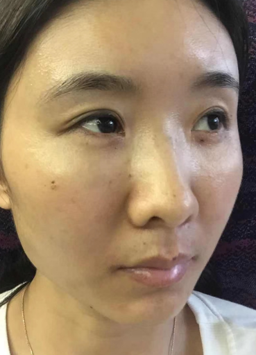 去眼袋手术