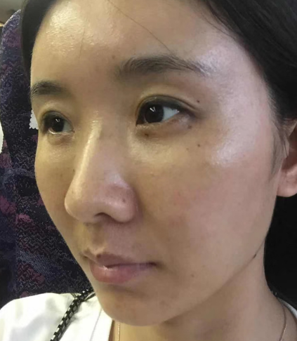 去眼袋手术