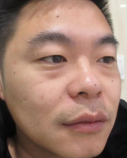 去眼袋手术