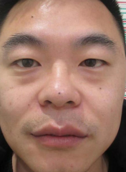 去眼袋手术