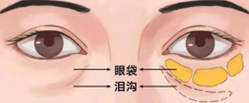 去眼袋手术