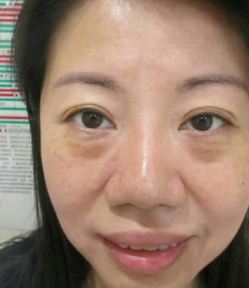 去眼袋手术